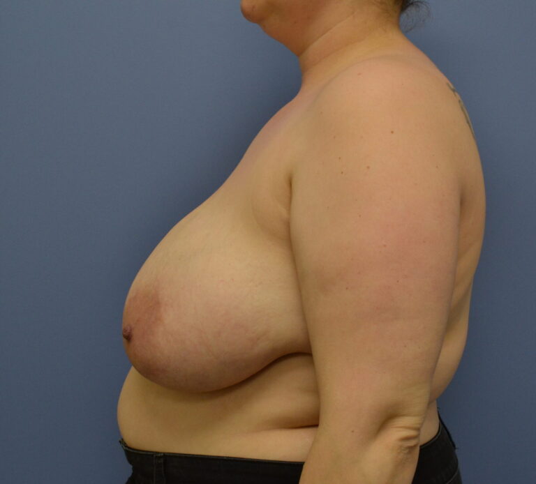 Before Image: Breast Reduction - left-side