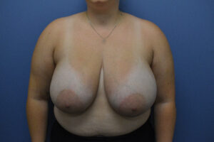 Before Image: Breast Reduction