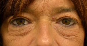 Before Image: Blepharoplasty