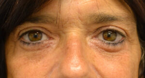 After Image: Blepharoplasty