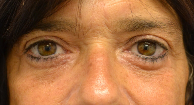 After Image: Blepharoplasty - front