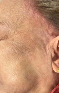 After Image: PicoWay Laser
