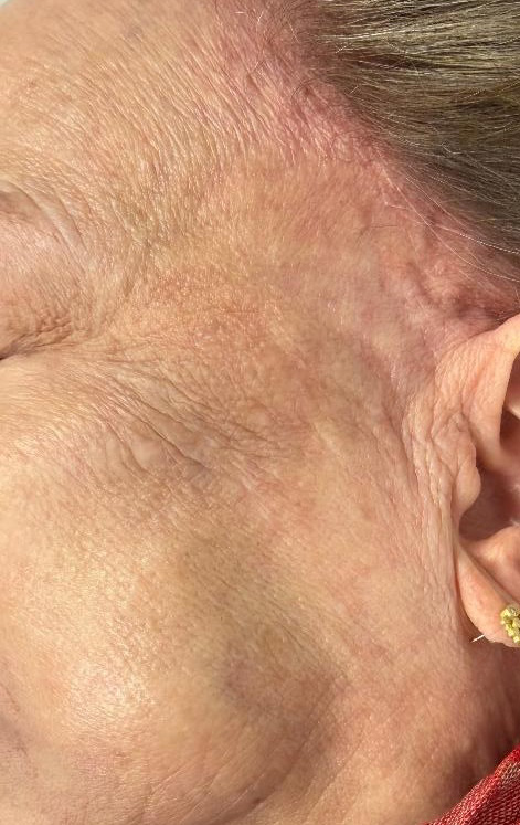 After Image: PicoWay Laser - left-side