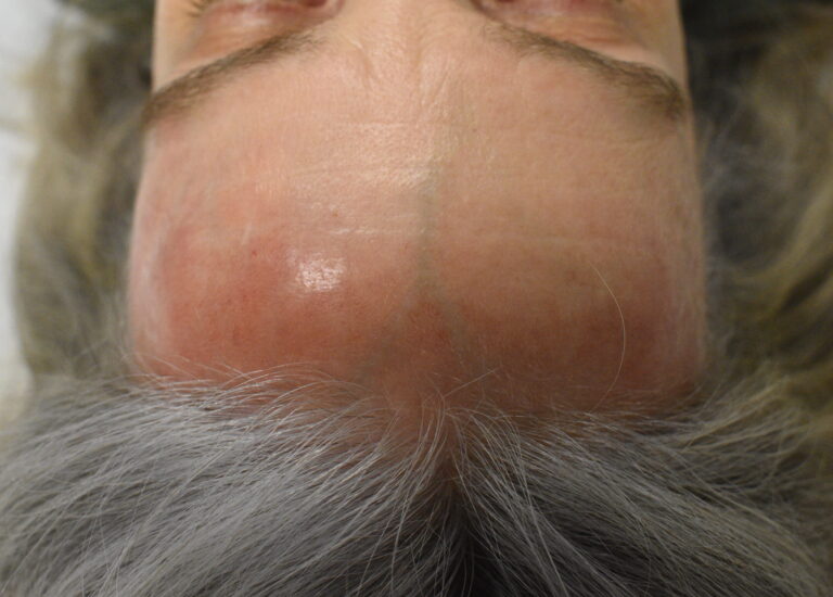 Before Image: VBeam Laser - front