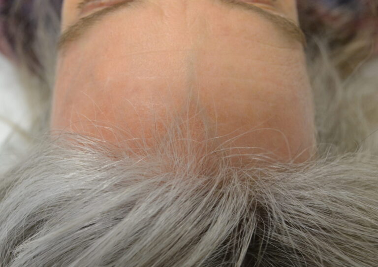 After Image: VBeam Laser - front