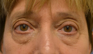 Before Image: Blepharoplasty lowers