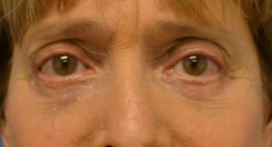 After Image: Blepharoplasty lowers