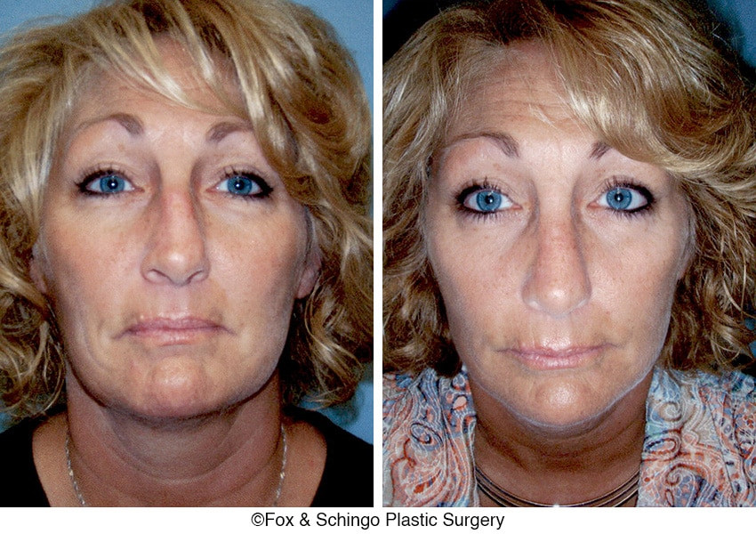 Rhinoplasty