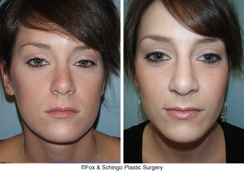 Rhinoplasty