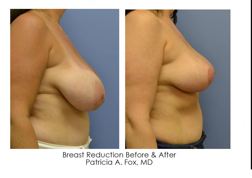 Breast Reduction
