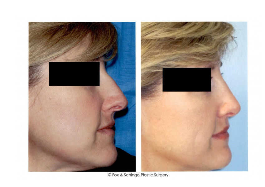 RHINOPLASTY